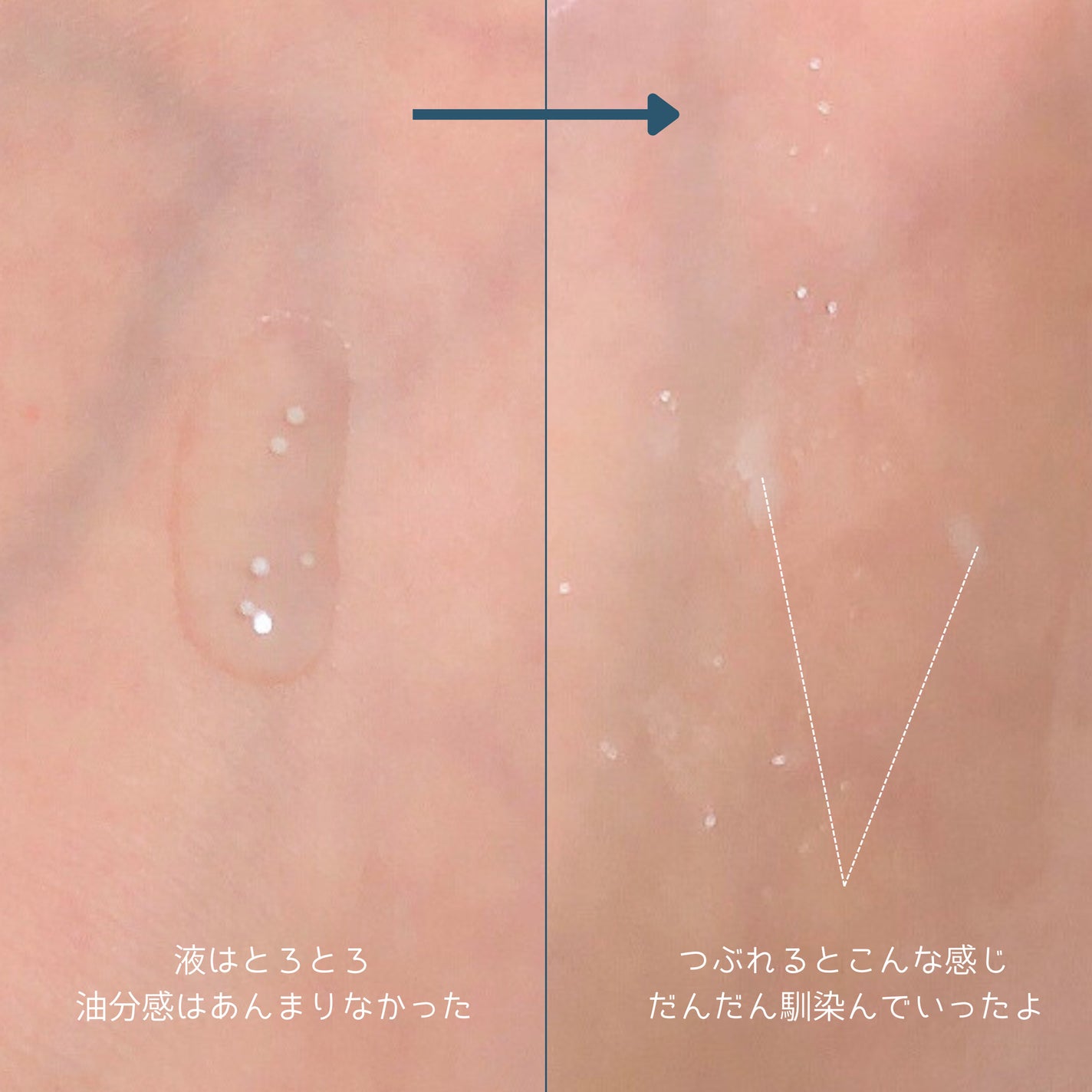 ナイアシンジンクビーズセラム/Frankly/美容液を使ったクチコミ(4枚目)