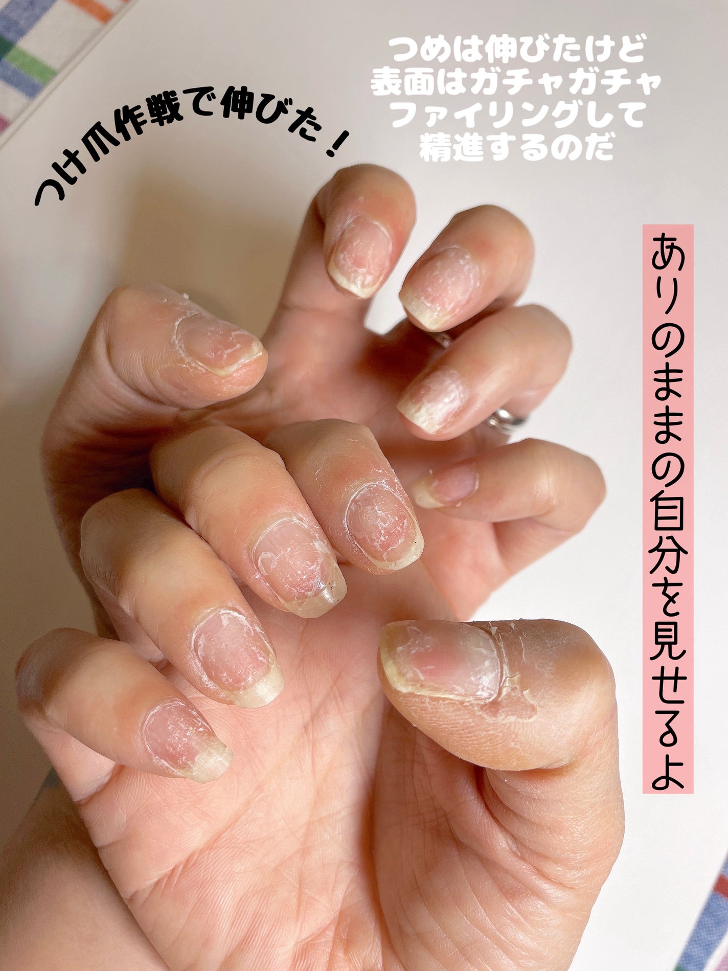 しのち☀️ on LIPS 「52歳まで爪を噛む癖が治らなかったけれど、ネイルチップをグルー..」(1枚目)