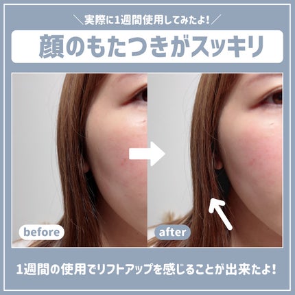 インモトックス小顔リフトアップペプチドショットクリーム&吸引ジェット/MEDITHERAPY/フェイスクリームを使ったクチコミ(5枚目)