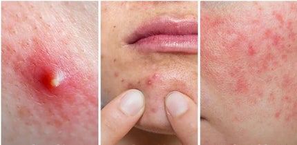 アゼライン酸16BBスージングセラム/MEDICUBE/美容液を使ったクチコミ(4枚目)