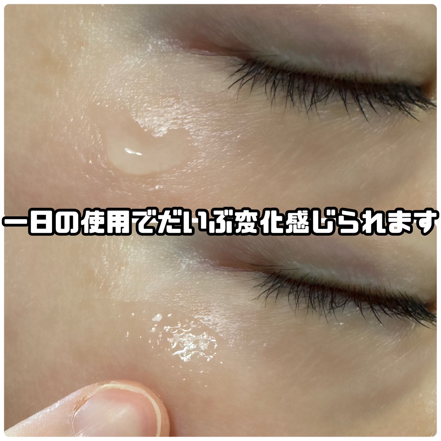 ☆scallop☆フォロバ100%☆ on LIPS 「【まさかの“チクチク美容”がここまで心地いいとは…!✨】韓国の..」(5枚目)