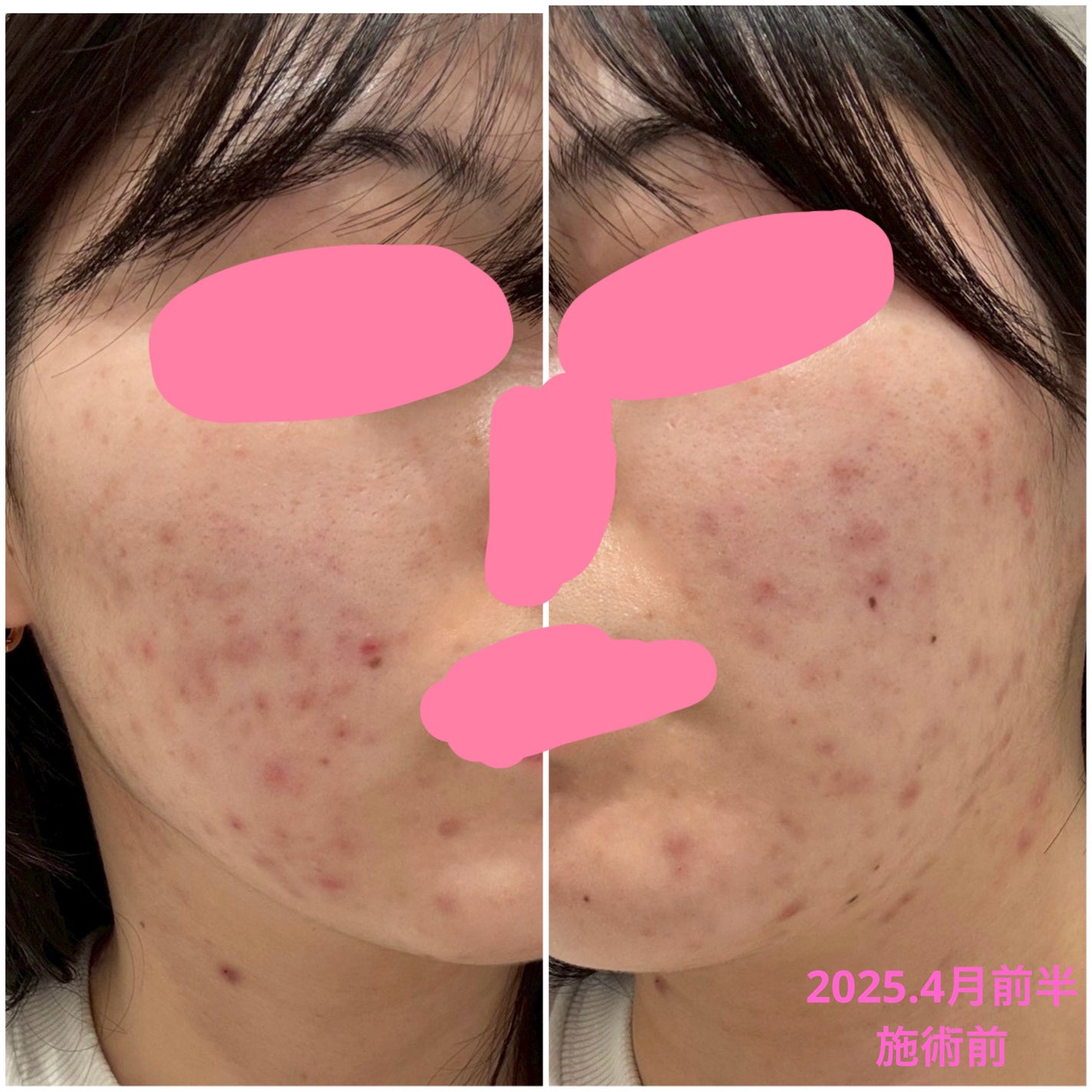 かもめねこ on LIPS 「肌荒れ見せるの苦しいんですが、リアルをお届けします!私はコロナ..」(3枚目)