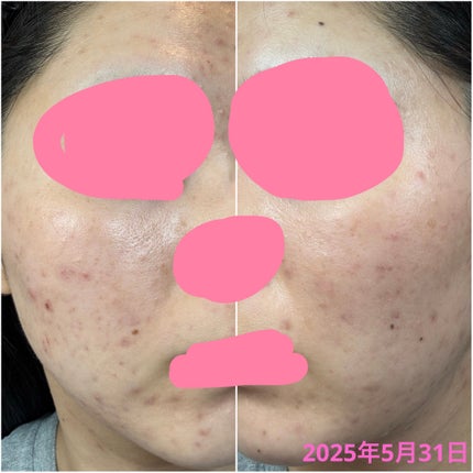 かもめねこ on LIPS 「肌荒れ見せるの苦しいんですが、リアルをお届けします!私はコロナ..」(6枚目)