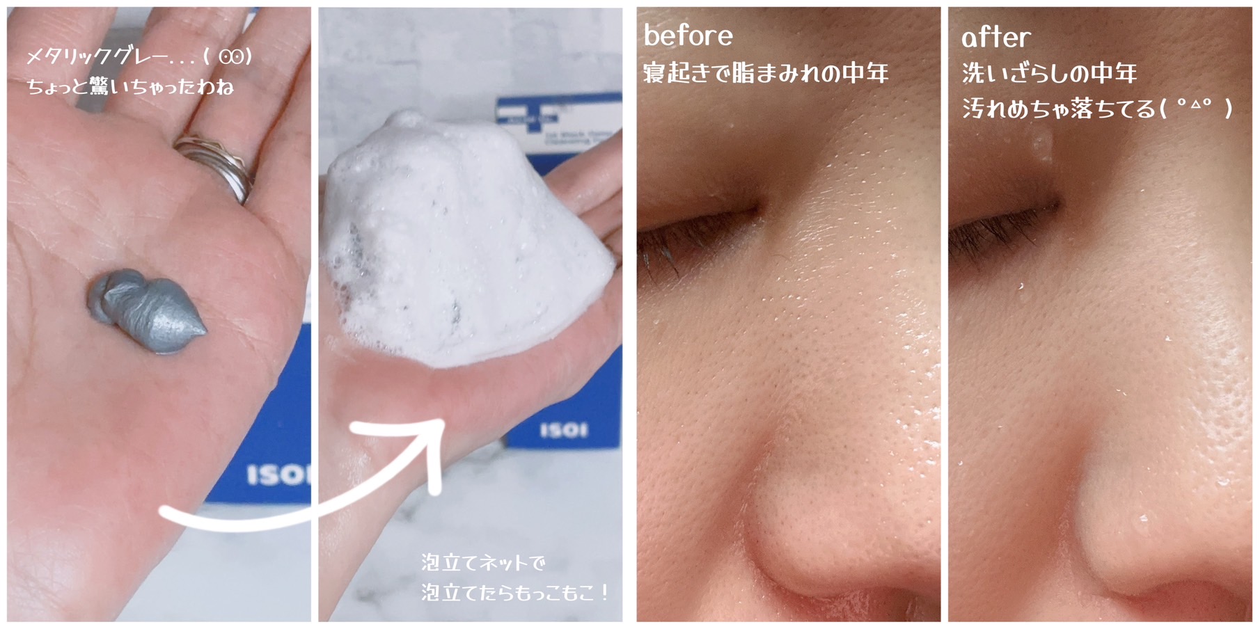 ACNI Dr. 1st Black Deep Clensing Foam/ISOI/洗顔フォームを使ったクチコミ（3枚目）