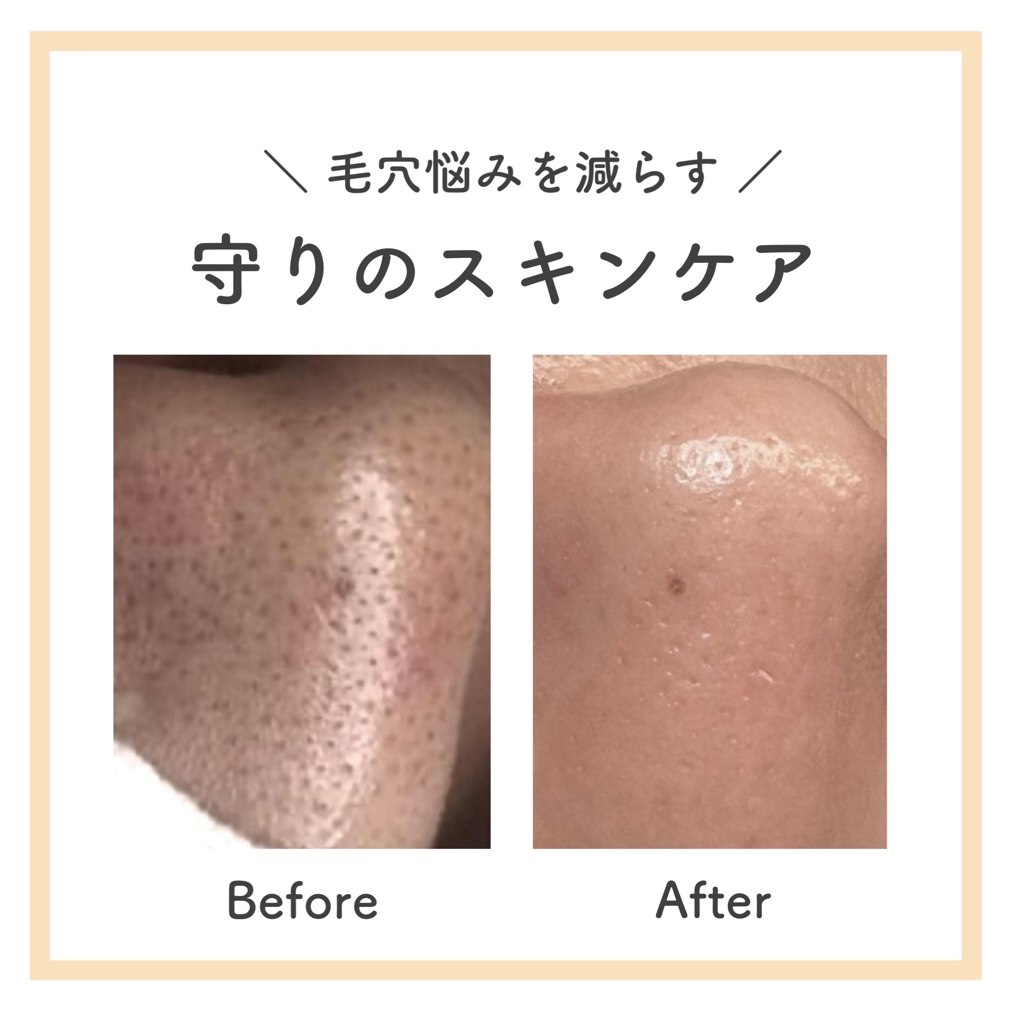 アトピアD 洗顔フォーム/アトピアD/洗顔フォームを使ったクチコミ（1枚目）