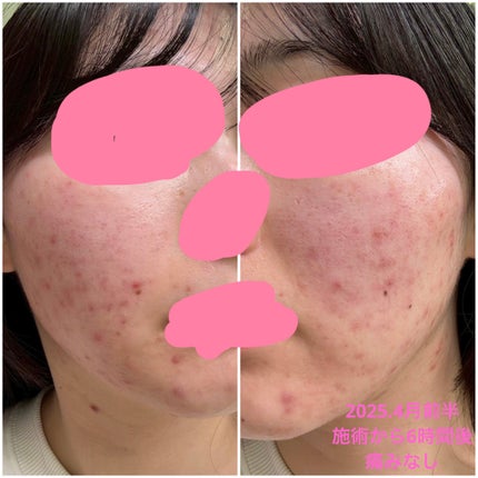 かもめねこ on LIPS 「肌荒れ見せるの苦しいんですが、リアルをお届けします!私はコロナ..」(5枚目)