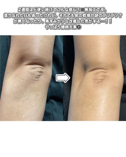 BnDアンダーアームクリーム(ボディクリーム)/BnD/デリケートゾーンケアを使ったクチコミ(4枚目)