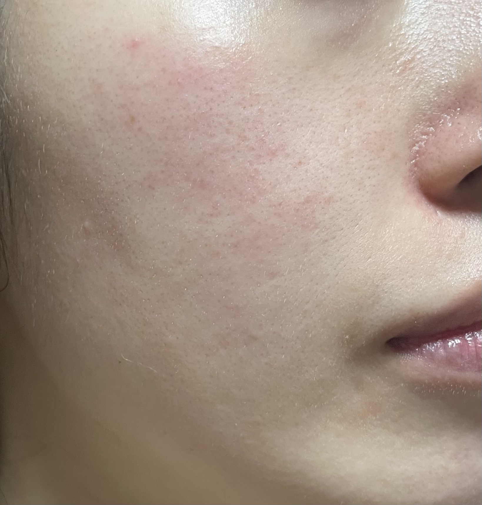 RXザ・アルファアルブチン2 ニキビ跡ケアセラム/COSRX/美容液を使ったクチコミ（3枚目）