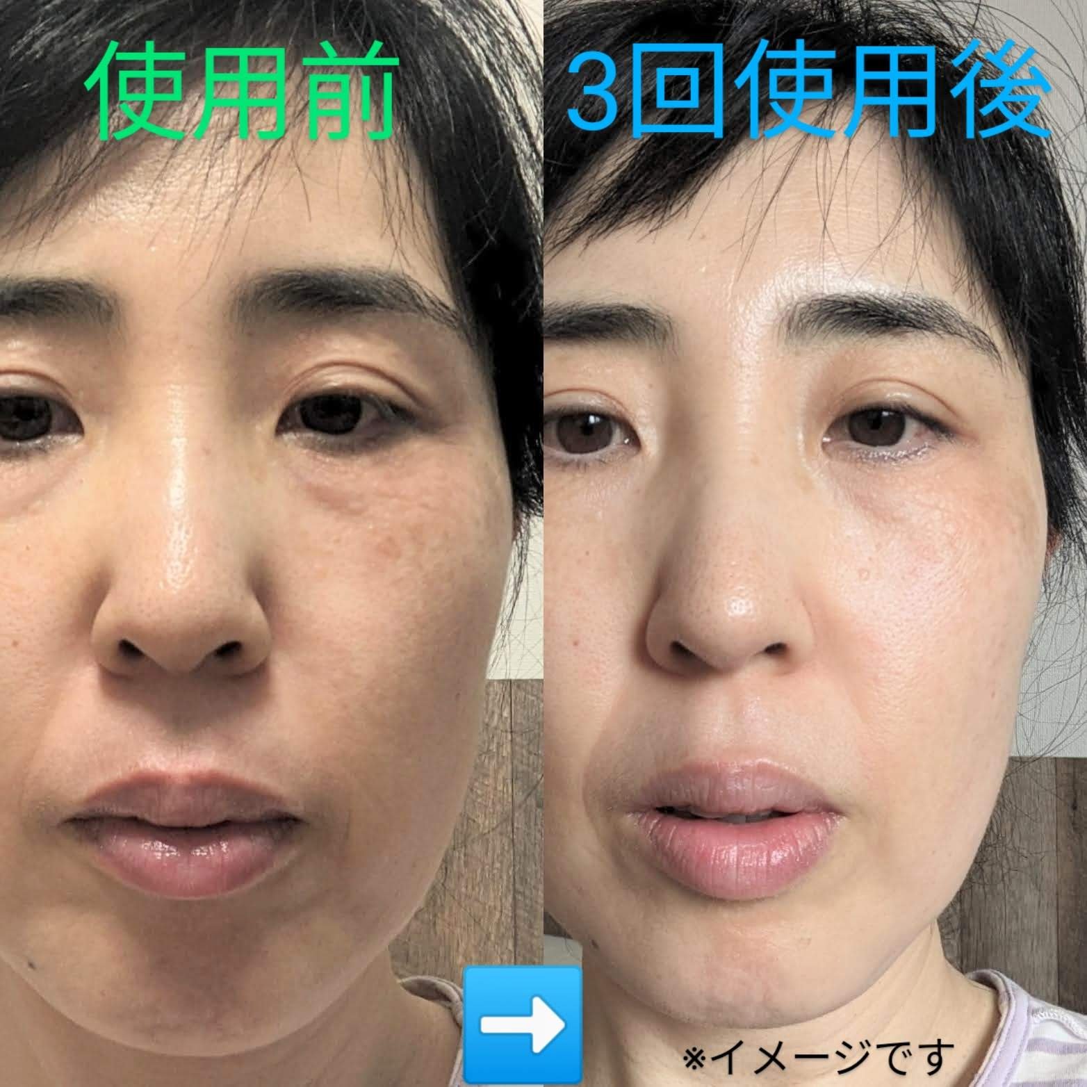 温冷リフトかっさ/ANLAN/美顔器・マッサージを使ったクチコミ（3枚目）