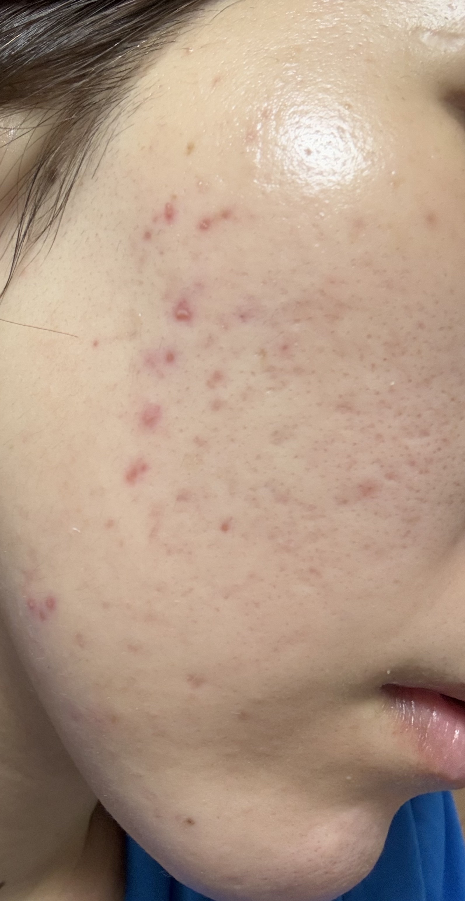 潤浸保湿 化粧水 III とてもしっとり/キュレル/化粧水を使ったクチコミ（2枚目）