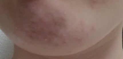 ノスカナイン トラブル セラム/FATION/美容液を使ったクチコミ(5枚目)