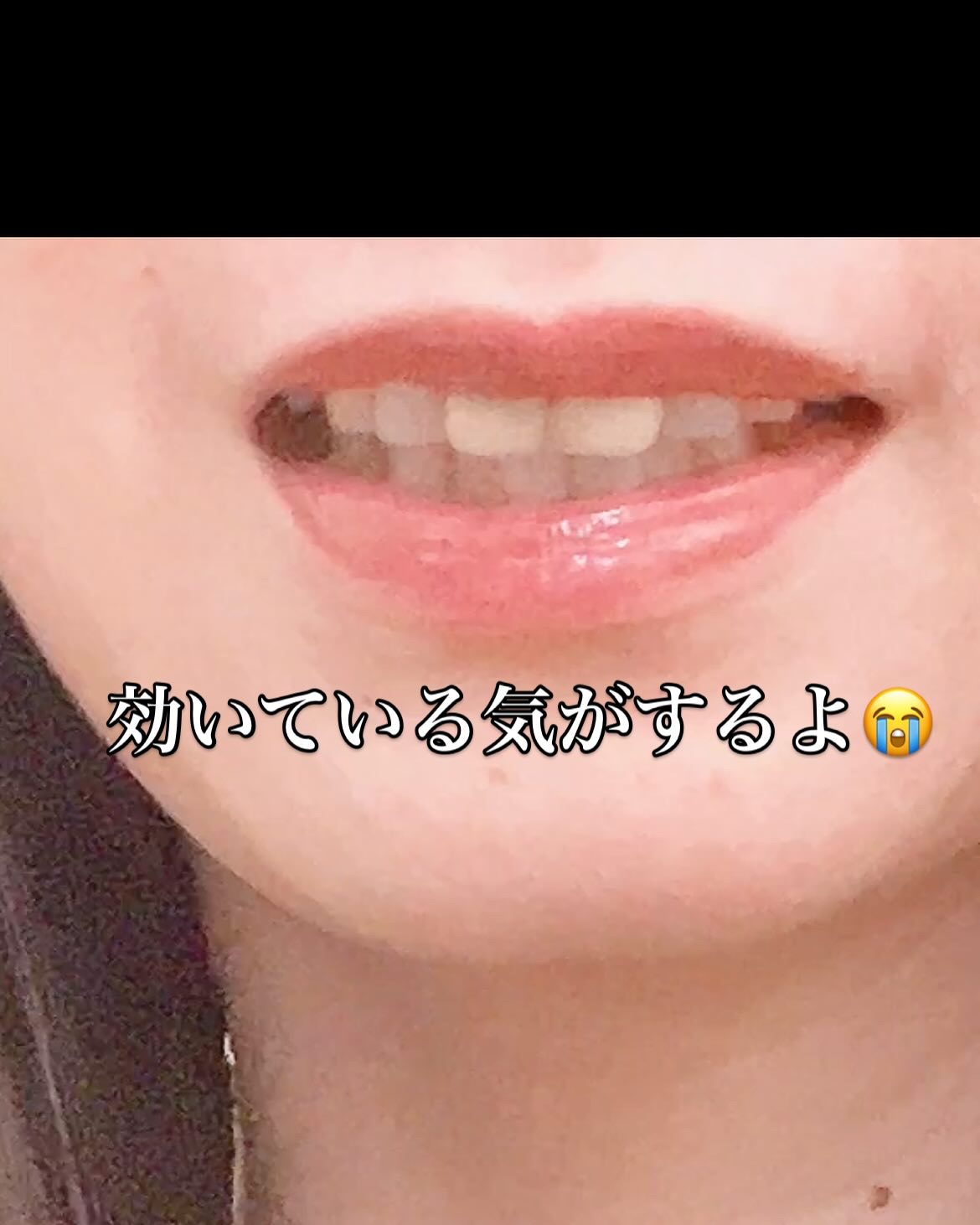 ニードルプランパー 電撃チェリー/Ui2./リッププランパーを使ったクチコミ（3枚目）