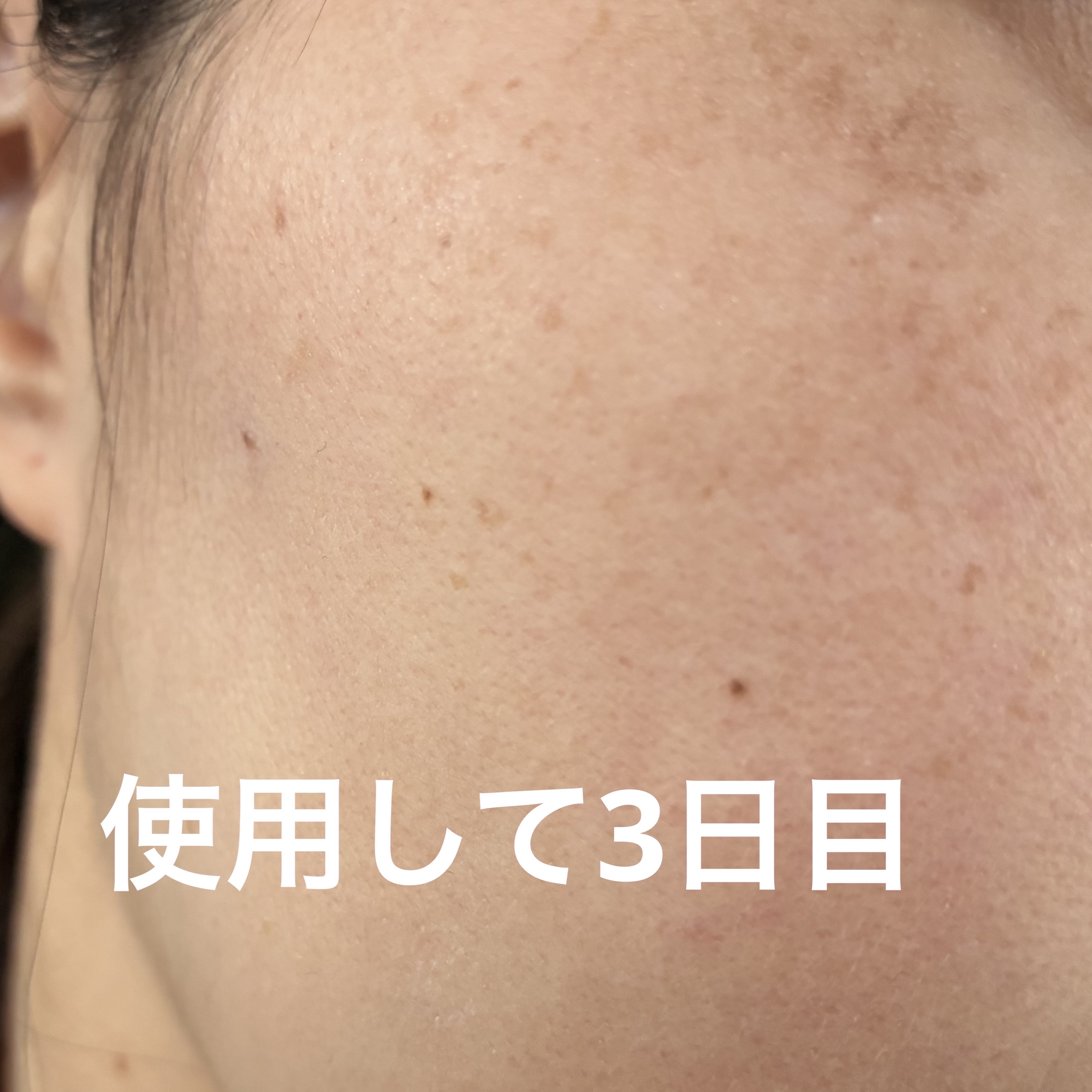 生VC美白美容液/Yunth/美容液を使ったクチコミ（3枚目）