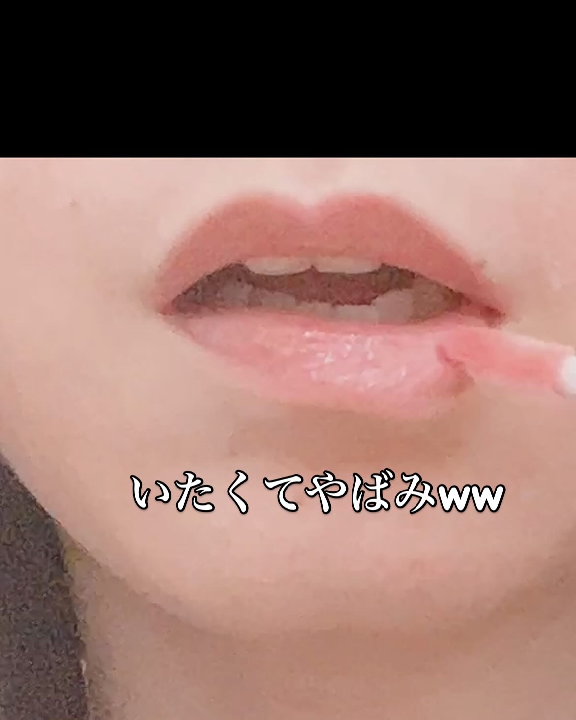 ニードルプランパー 電撃チェリー/Ui2./リッププランパーを使ったクチコミ（2枚目）