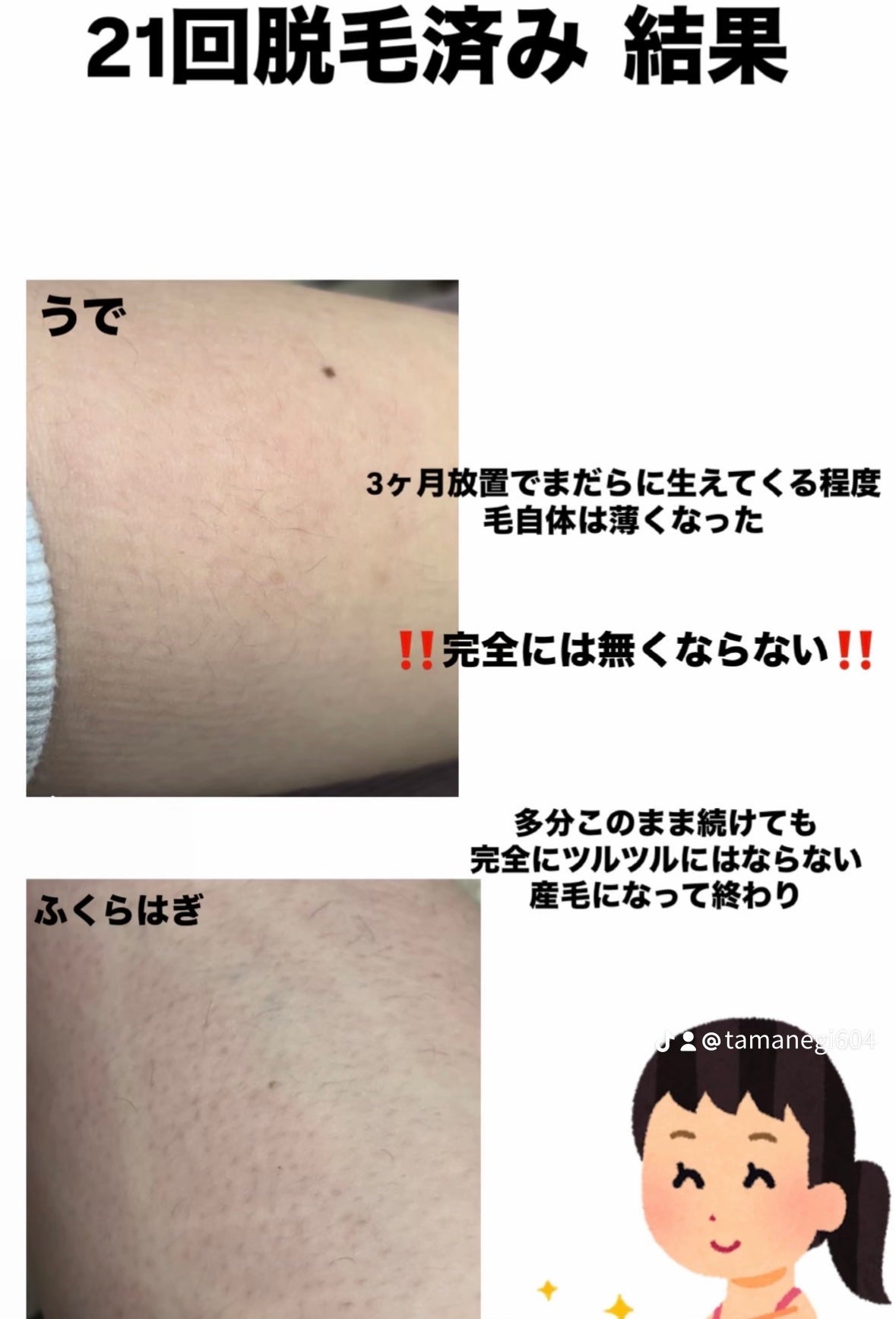 たまねぎ on LIPS 「脱毛行く前に絶対見て‼️脱毛の注意点⚠️脱毛は言わずもがな医療..」(6枚目)