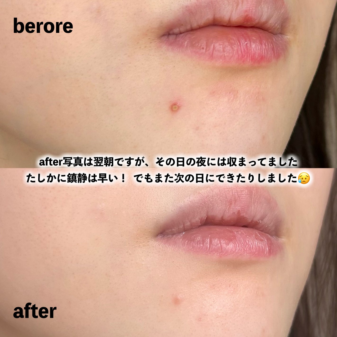 ガーリック リードルショット スポットクリーム/VT/フェイスクリームを使ったクチコミ(5枚目)