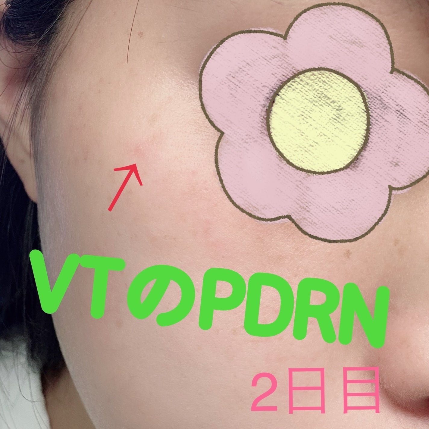 えりゅたん@がんばれない on LIPS 「7日間ツヤ肌チャレンジ‼️VTから出ているPDRNシリーズのパ..」(2枚目)