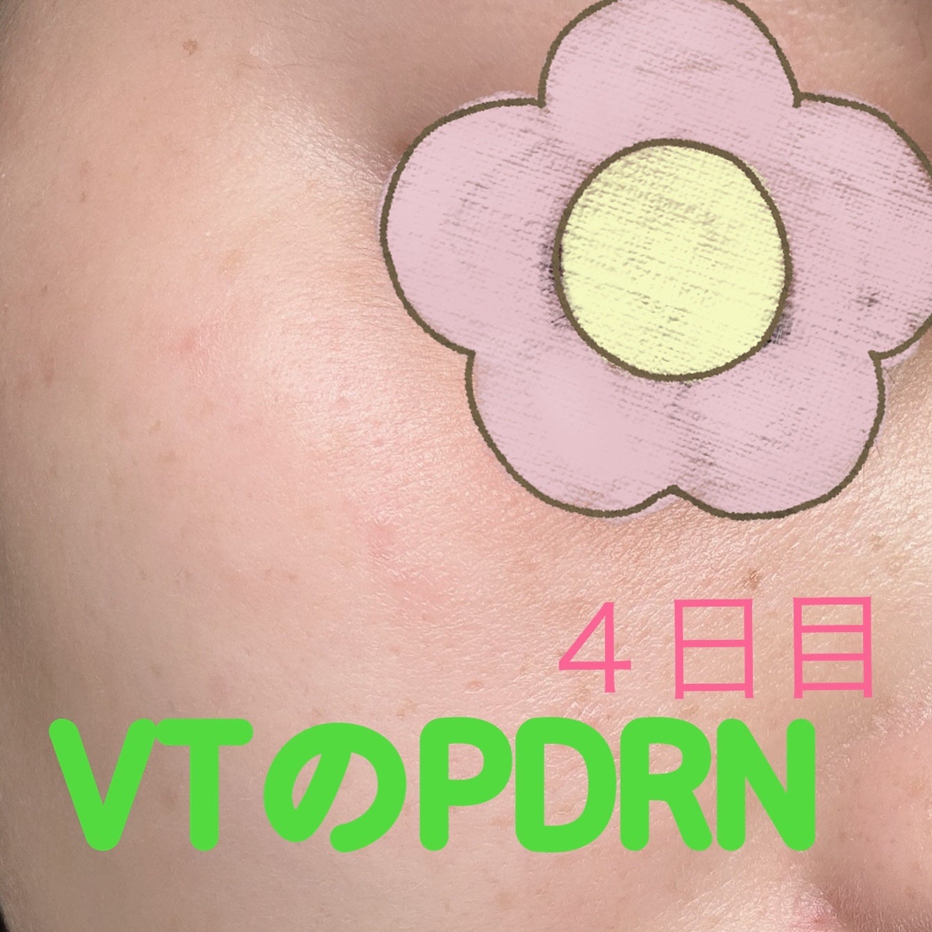 えりゅたん@がんばれない on LIPS 「7日間ツヤ肌チャレンジ‼️VTから出ているPDRNシリーズのパ..」(4枚目)