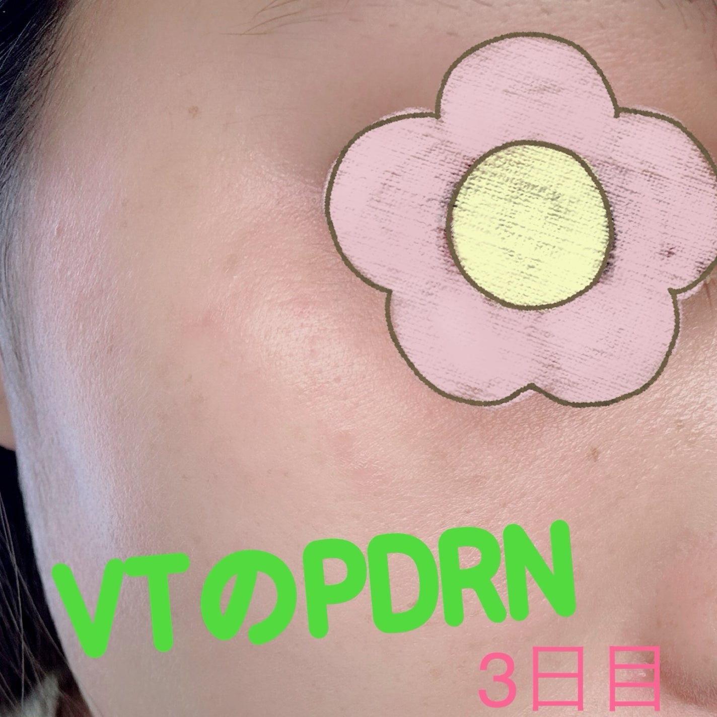 えりゅたん@がんばれない on LIPS 「7日間ツヤ肌チャレンジ‼️VTから出ているPDRNシリーズのパ..」(3枚目)