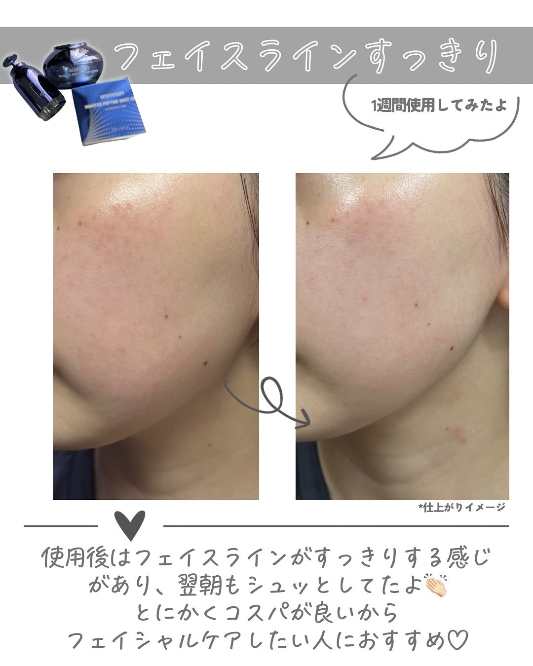 インモトックス小顔リフトアップペプチドショットクリーム&吸引ジェット/MEDITHERAPY/フェイスクリームを使ったクチコミ(5枚目)