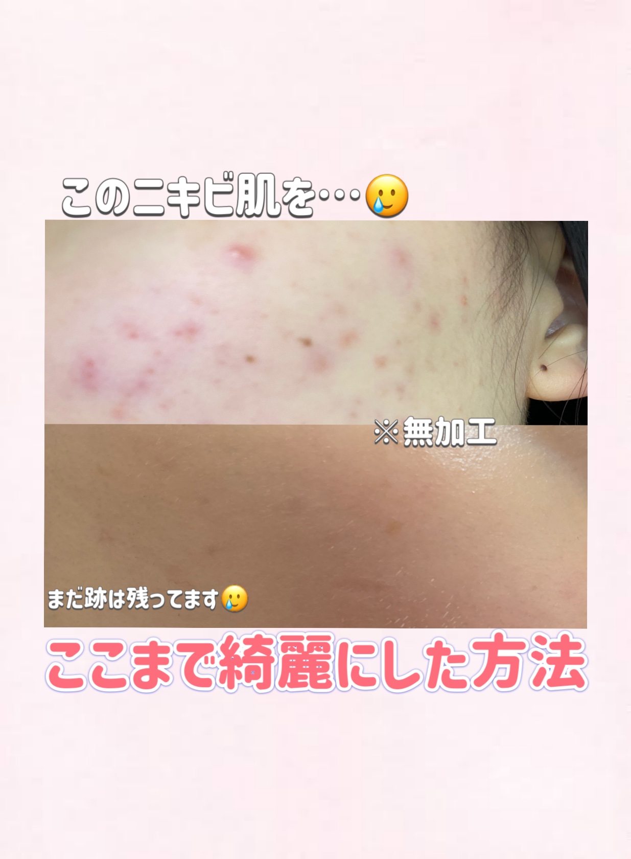 オードムーゲ 薬用ローション（ふきとり化粧水）/オードムーゲ/拭き取り化粧水を使ったクチコミ（1枚目）