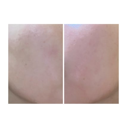 ぽむ on LIPS 「2023.9.13皮膚科に受診 エピデュオとヘパリン処方1枚目..」(4枚目)