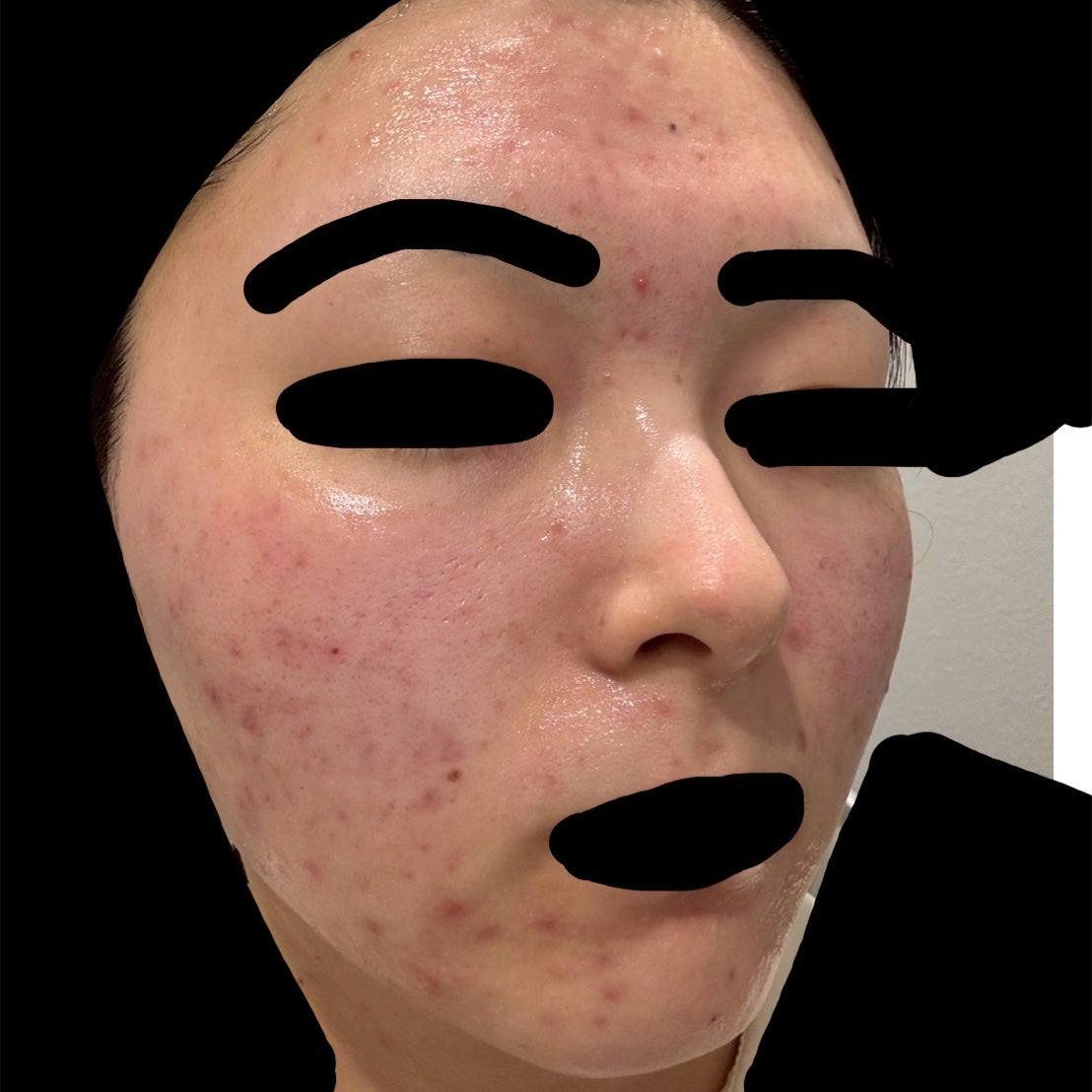 かもめねこ on LIPS 「【ジュベルック2回目レポ】麻酔込み全額38500円⬆️トリビュ..」(4枚目)