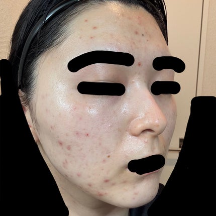 かもめねこ on LIPS 「【ジュベルック2回目レポ】麻酔込み全額38500円⬆️トリビュ..」(7枚目)