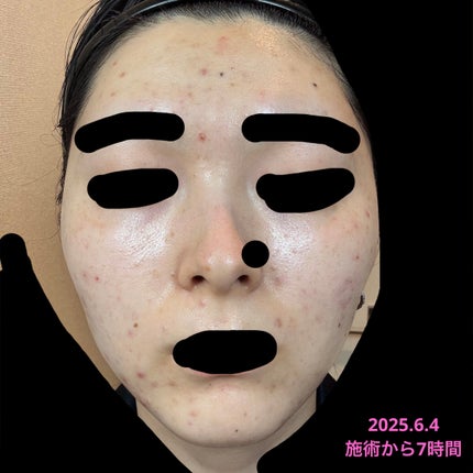 かもめねこ on LIPS 「【ジュベルック2回目レポ】麻酔込み全額38500円⬆️トリビュ..」(5枚目)