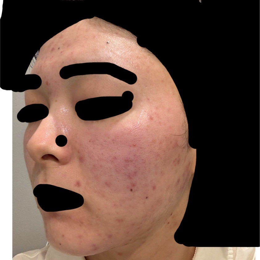 かもめねこ on LIPS 「【ジュベルック2回目レポ】麻酔込み全額38500円⬆️トリビュ..」(3枚目)