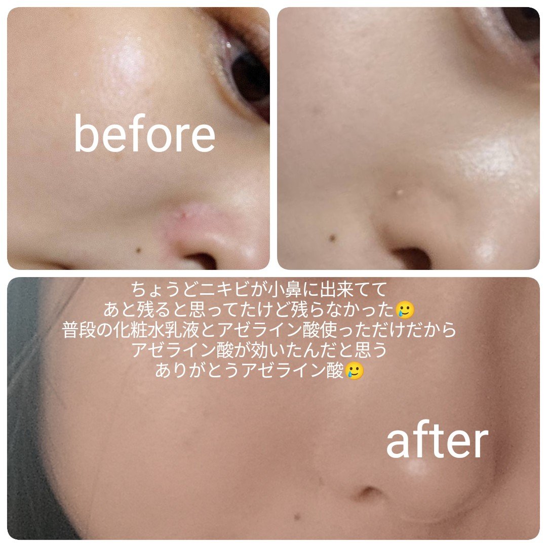 A1カーミング アンプル/VT/美容液を使ったクチコミ（2枚目）