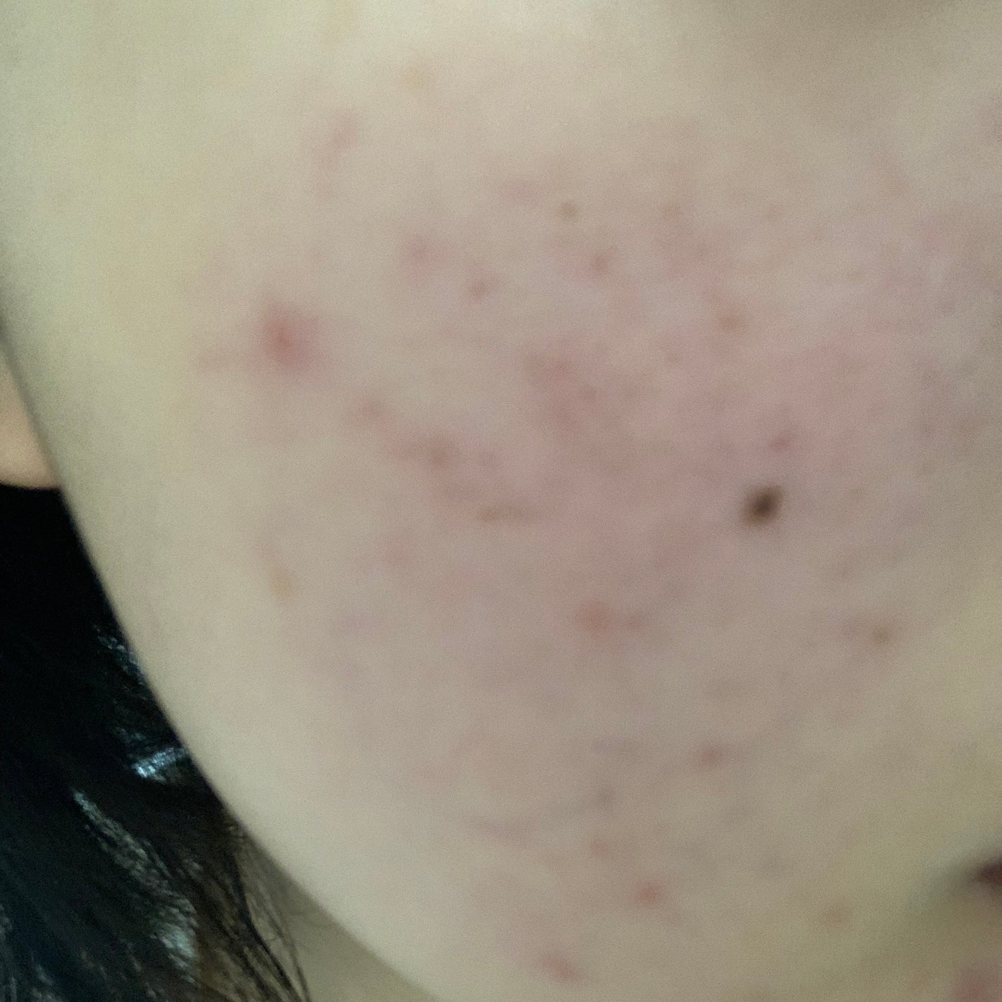 さく on LIPS 「今日のお肌✨だいぶ調子がいいあとはこの色素沈着してしまったニキ..」(3枚目)