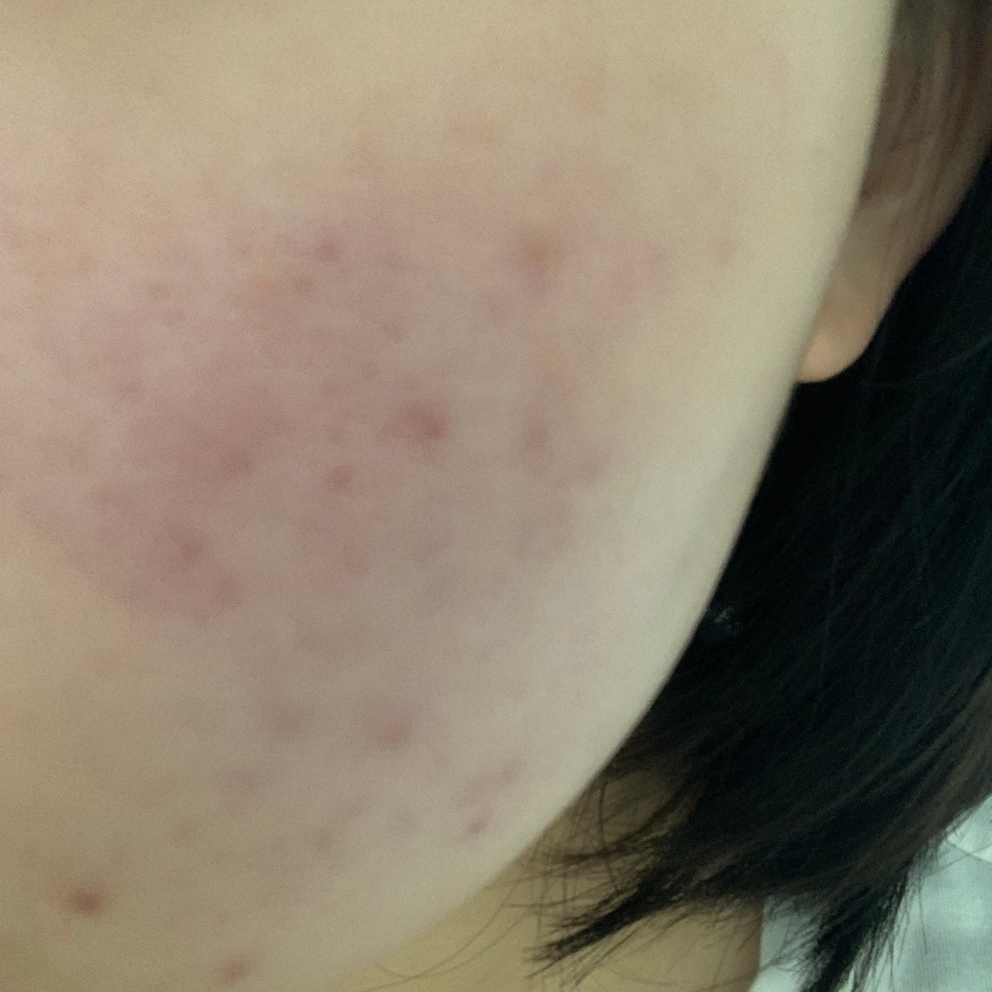 さく on LIPS 「今日のお肌✨だいぶ調子がいいあとはこの色素沈着してしまったニキ..」(2枚目)