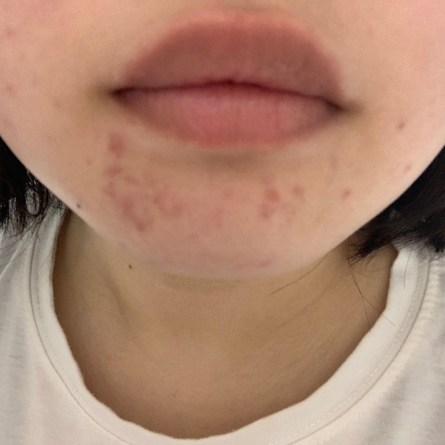 さく on LIPS 「今日のお肌✨だいぶ調子がいいあとはこの色素沈着してしまったニキ..」(4枚目)
