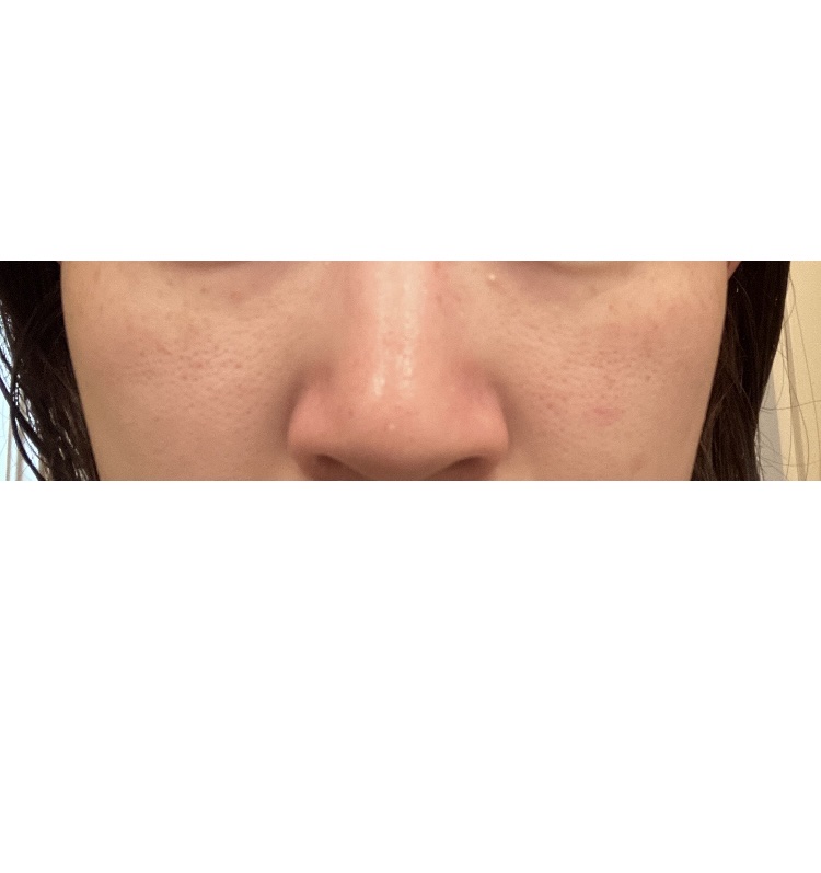 DETクリア ブライト＆ピール ピーリングジェリー<ミックスフルーツの香り>/Detclear/ピーリングを使ったクチコミ（1枚目）