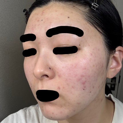 かもめねこ on LIPS 「6/6夜#ポテンツァ#ジュベルック#美容医療#肌治療..」(4枚目)