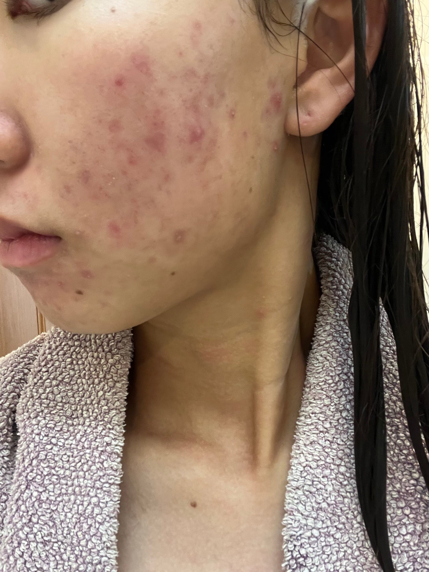 も on LIPS 「ほっぺの、痛い系ニキビが悪化してしんどい。薬も3食とは言わずと..」(3枚目)