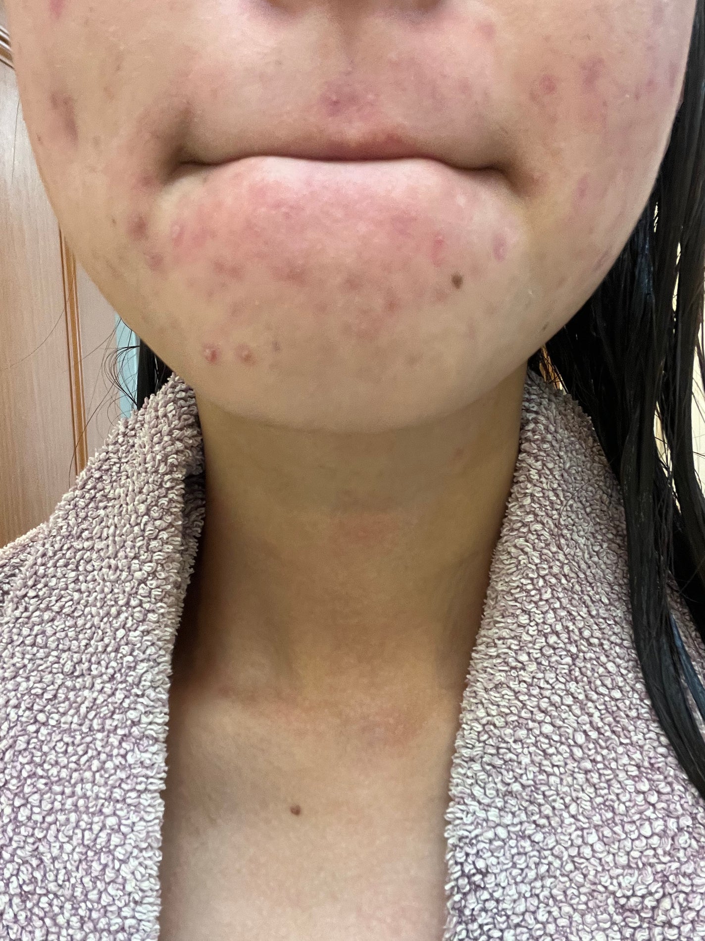 も on LIPS 「ほっぺの、痛い系ニキビが悪化してしんどい。薬も3食とは言わずと..」(2枚目)