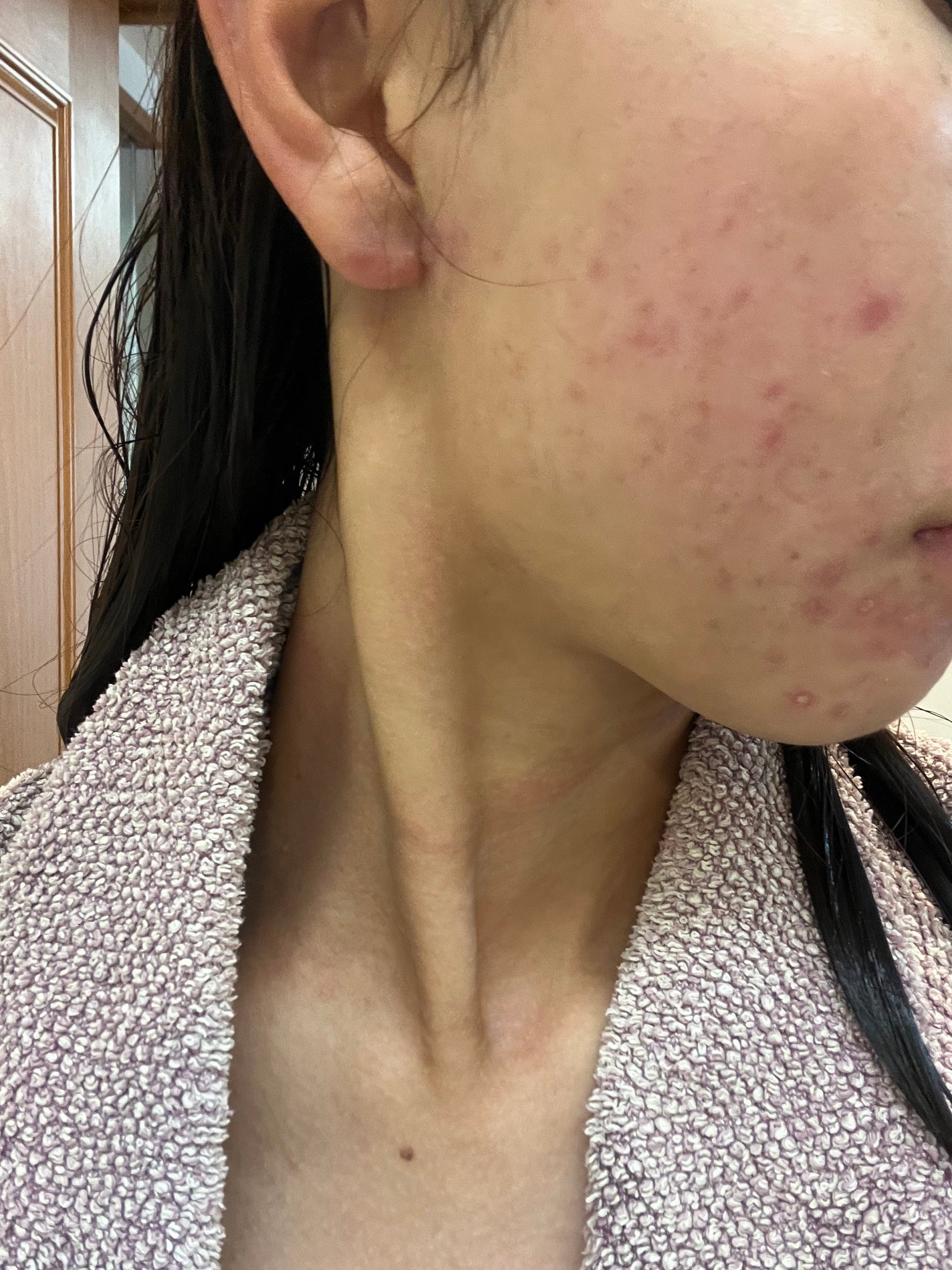 も on LIPS 「ほっぺの、痛い系ニキビが悪化してしんどい。薬も3食とは言わずと..」(4枚目)