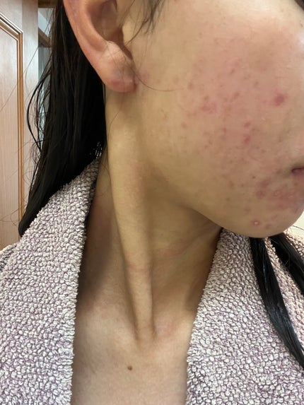 も on LIPS 「ほっぺの、痛い系ニキビが悪化してしんどい。薬も3食とは言わずと..」(4枚目)