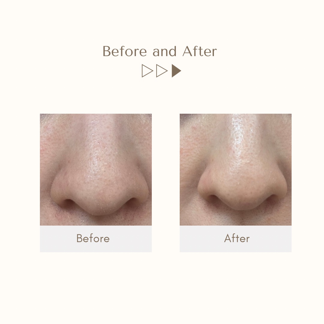 ILSO NATURAL MILD CLEAR NOSE PACK (DONKI 限定)/ilso/その他キットセットを使ったクチコミ（3枚目）