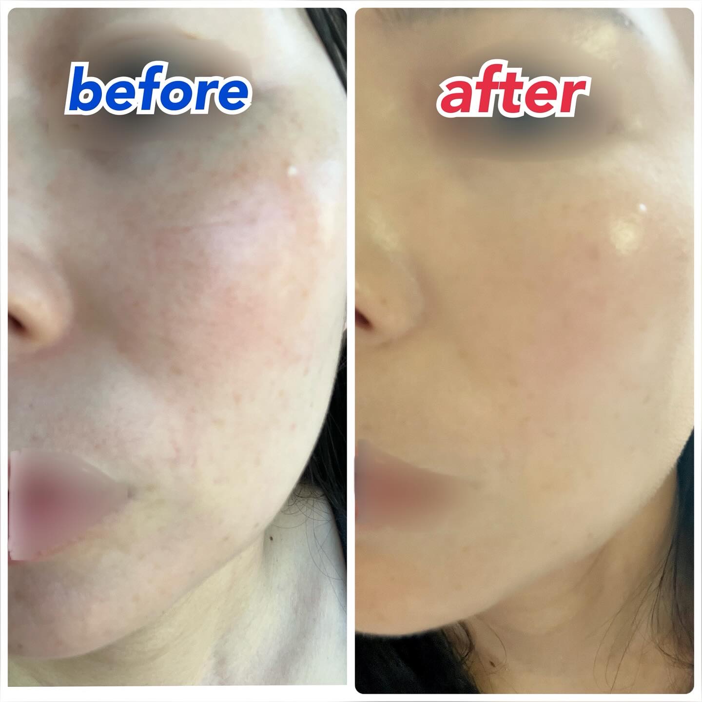 Easydew イージーデュー メラB トーニングセラムクッションのクチコミ「Easydew メラB トーニングセラムクッション

肌荒れしやすいタイプで、今までファンデー.....」（2枚目）