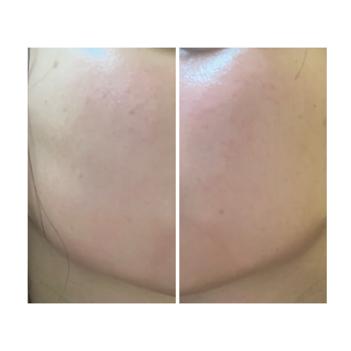 ぽむ on LIPS 「2023.9.13皮膚科に受診 エピデュオとヘパリン処方1枚目..」(1枚目)