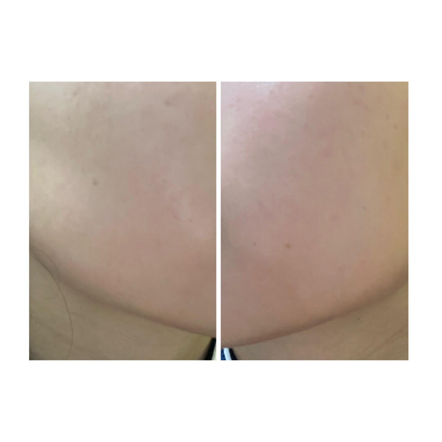 ぽむ on LIPS 「2023.9.13皮膚科に受診 エピデュオとヘパリン処方1枚目..」(2枚目)