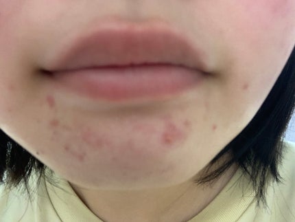 さく on LIPS 「今日のお肌✨だいぶ改善されました!ニキビ跡が消えるクリームやセ..」(4枚目)