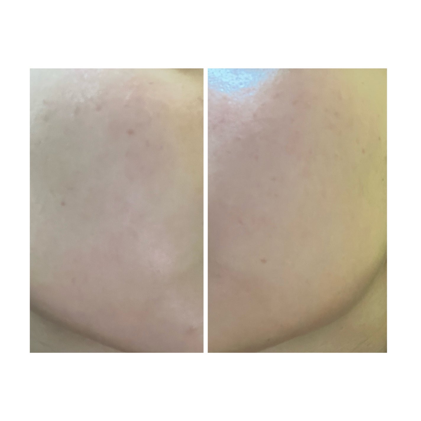 ぽむ on LIPS 「2023.9.13皮膚科に受診 エピデュオとヘパリン処方1枚目..」(5枚目)