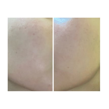 ぽむ on LIPS 「2023.9.13皮膚科に受診 エピデュオとヘパリン処方1枚目..」(5枚目)