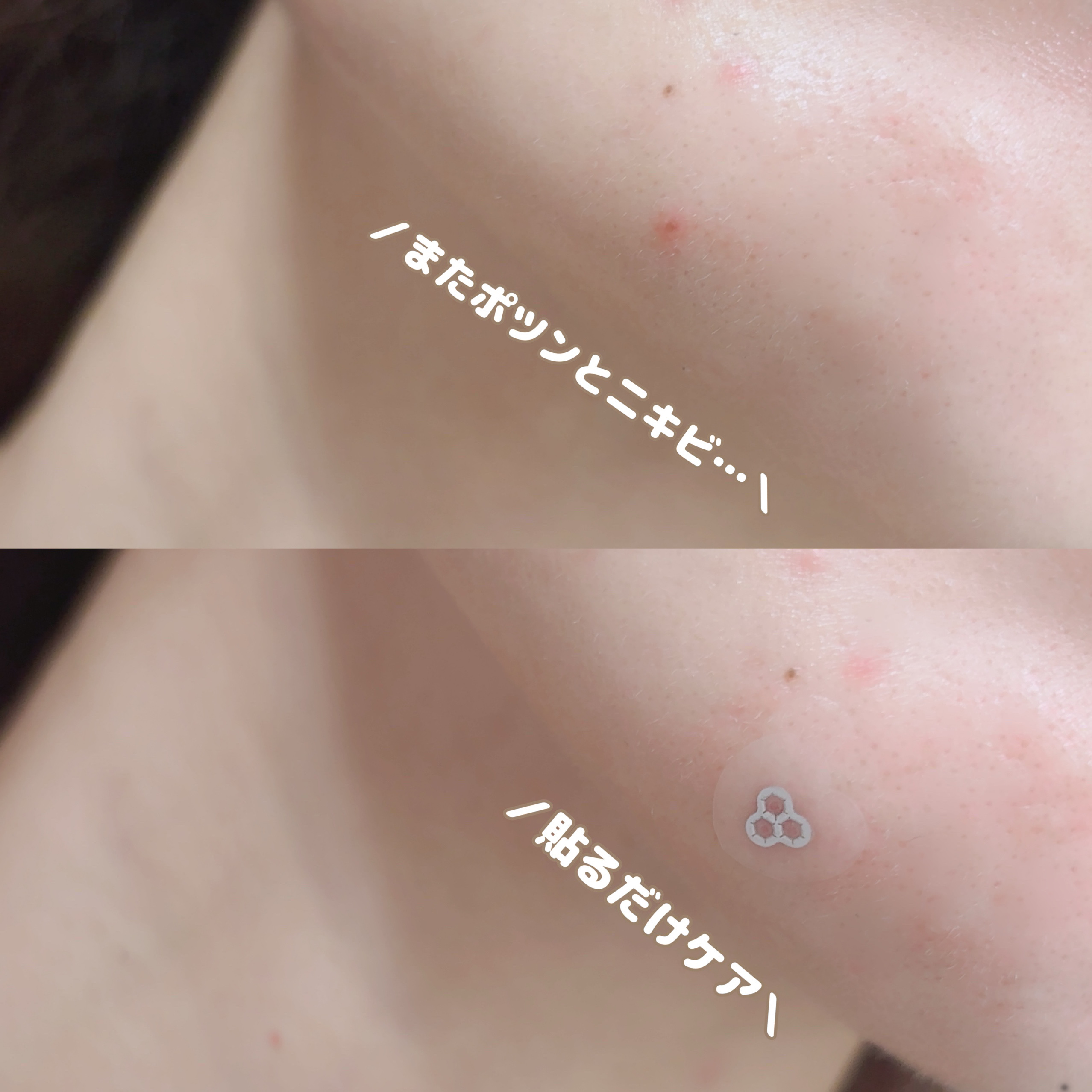 ACマグネシウムパッチ/スノーツープラス/シートマスク・パックを使ったクチコミ（3枚目）