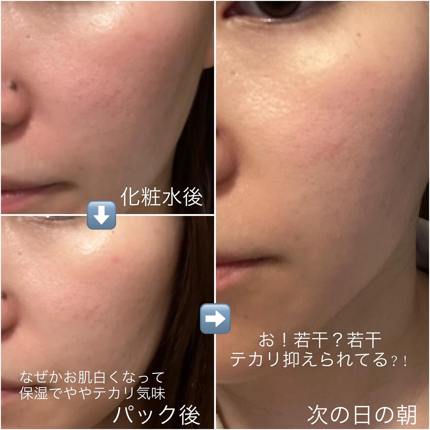 ダーマレーザー スーパーAZ100マスク/クオリティファースト/シートマスク・パックを使ったクチコミ(5枚目)