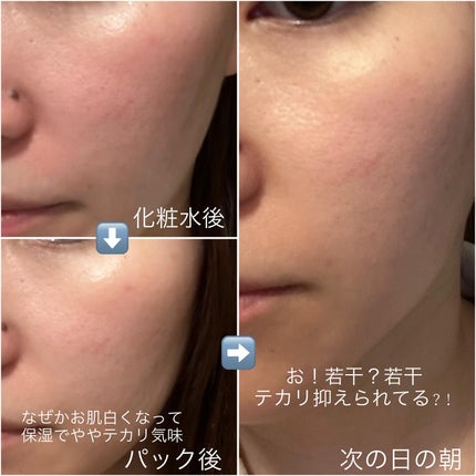 ダーマレーザー スーパーAZ100マスク/クオリティファースト/シートマスク・パックを使ったクチコミ(5枚目)